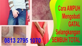 Obat Gatal Selangkangan Kelamin Herbal Ampuh | Obat Gatal De Nature