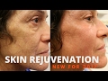 Skin Rejuvenation- Before & Afters