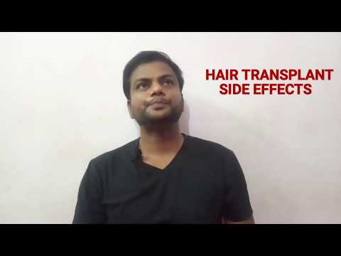 hair-transplant-side-effects-|-hair-transplant-side-effects