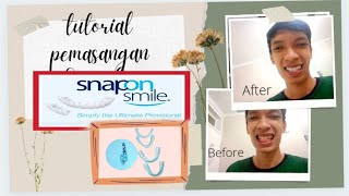 Tutorial cara memakai Snap on Smile yang baik dan benar #Snaponsmile #veneers