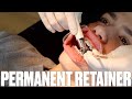 GETTING PERMANENT RETAINER GLUED TO HIS TEETH AND MOUTHFUL OF PAINFUL INTERARCH RUBBER BANDS BRACES