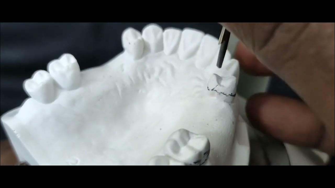 Principles of surveying and designing of removable partial denture