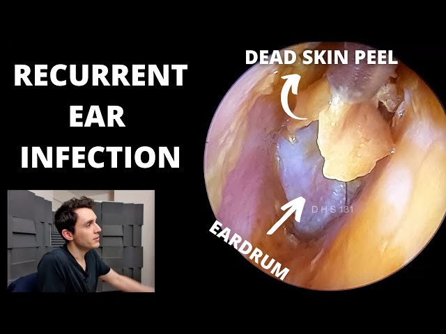 Stripping Dead Skin From Infected Ear (Prostaglandins Discussed) class=