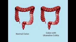 Type of ulcerative colitis / انواع القولون التقرحى