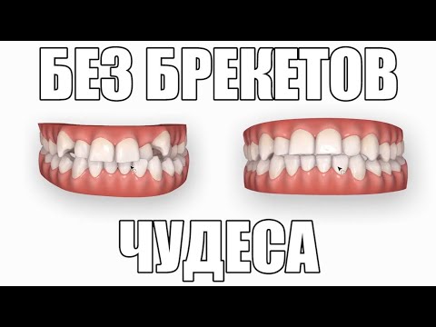 Без брекетов с Инвизилайн в Алматы, до и после лечения