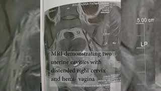 Herlyn - Werner - wunderlich - Syndrome (Prof. Hedi REZIGA)