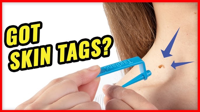 Cryotag Skin Tag Remover - Boots