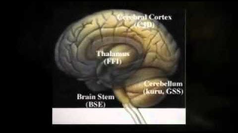 fatal familial insomnia