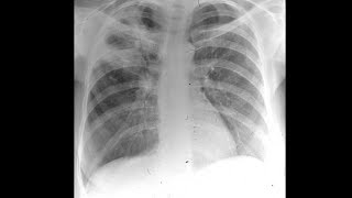 Mayo Clinic Minute: Understanding tuberculosis