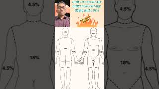 how to calculate burn percentage  using rule of nine #best #doctor #burn #burning