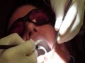 Laser Bacterial Reduction At Aristo Dental Laser Bacterial Reduction At Aristo Dental