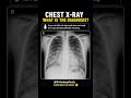 Classic Pediatric Chest X-ray Finding | Diagnosis Challenge #neetpg #xray #icu  @DrHardeepPeads