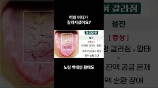 혓바닥이 갈라져요. 혀가 갈라지는 이유