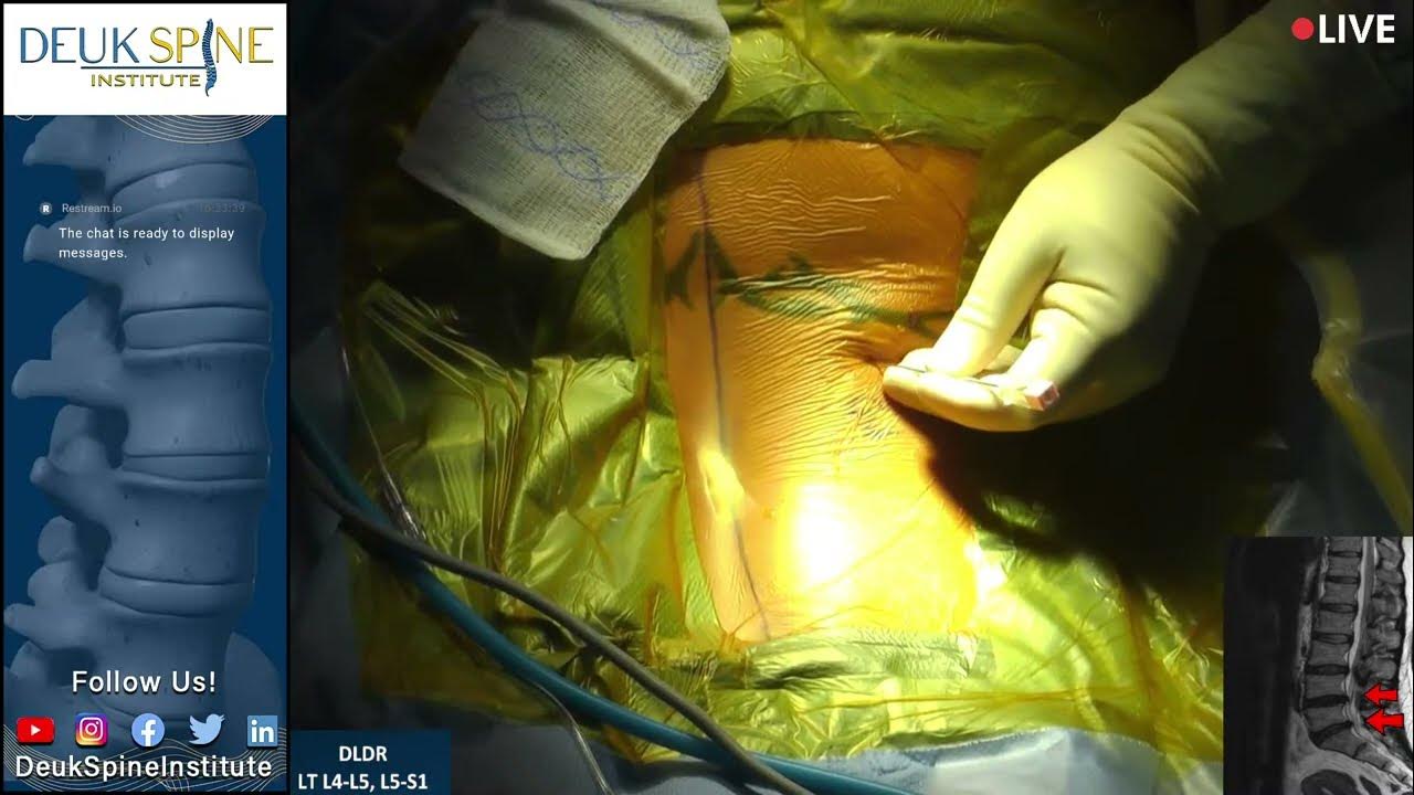 Watch Live Spine Surgery! Deuk Laser Disc Repair LT L4L5, L5S1 YouTube