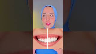 علاج الابتسامة اللثوية  dentist teeth