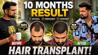 Hair Transplant in Jaipur (HX-ESBJ) | Best Results &amp; Cost of Hair Transplant in Jaipur
