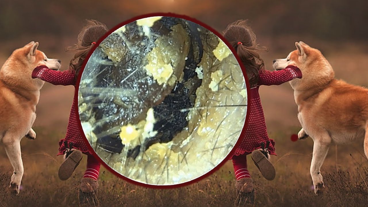 耳垢除去聴覚専門家 ear wax removal audiology associates part 438 YouTube