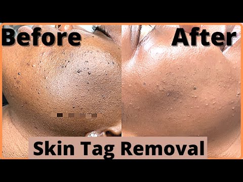 How To Remove Skin Tag | Skin Tag Removal