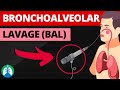 Bronchoalveolar Lavage BAL Medical Definition Quick Explainer Video Bronchoalveolar Lavage BAL Medical Definition Quick Explainer Video