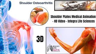 Shoulder Plates Medical Animation - HD Video - Integra Life Sciences | medical animation video