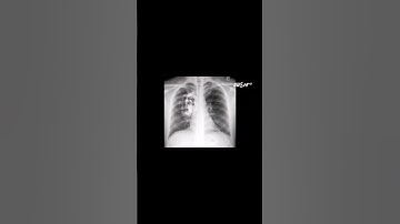 Các triệu chứng thường gặp của Ung Thư phổi! Bạn có không?