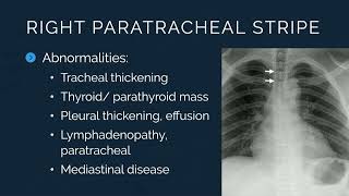 101 Lines, Stripes and Interfaces – A Chest Radiograph Primer  Medstudylab.com