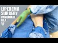 Lipedema reduction surgery  immediate before  after  total lipedema care