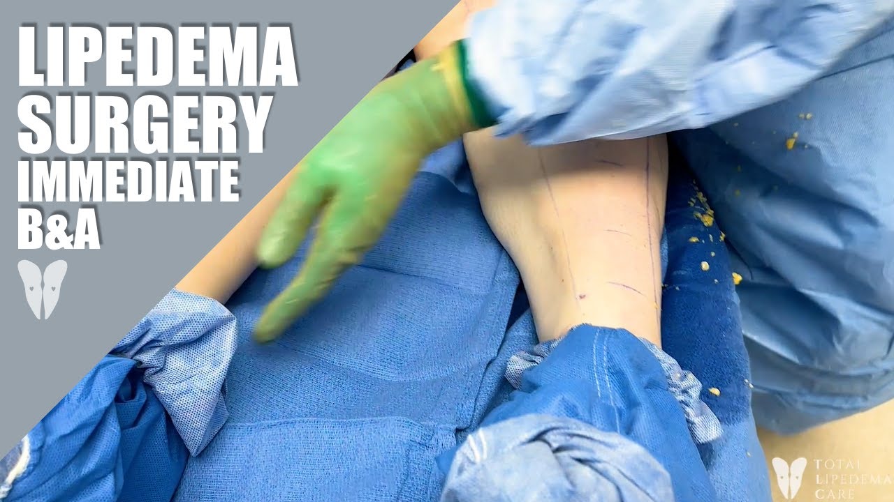 Lipedema Reduction Surgery Immediate Before & After Total Lipedema