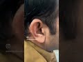 Otoplasty surgery in lahore Pakistan by dr Saleem. #otoplasty #otoplastysurgery #drsaleem