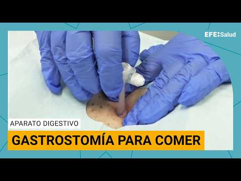 Gastrostomía: alimentos y fármacos directos al estómago