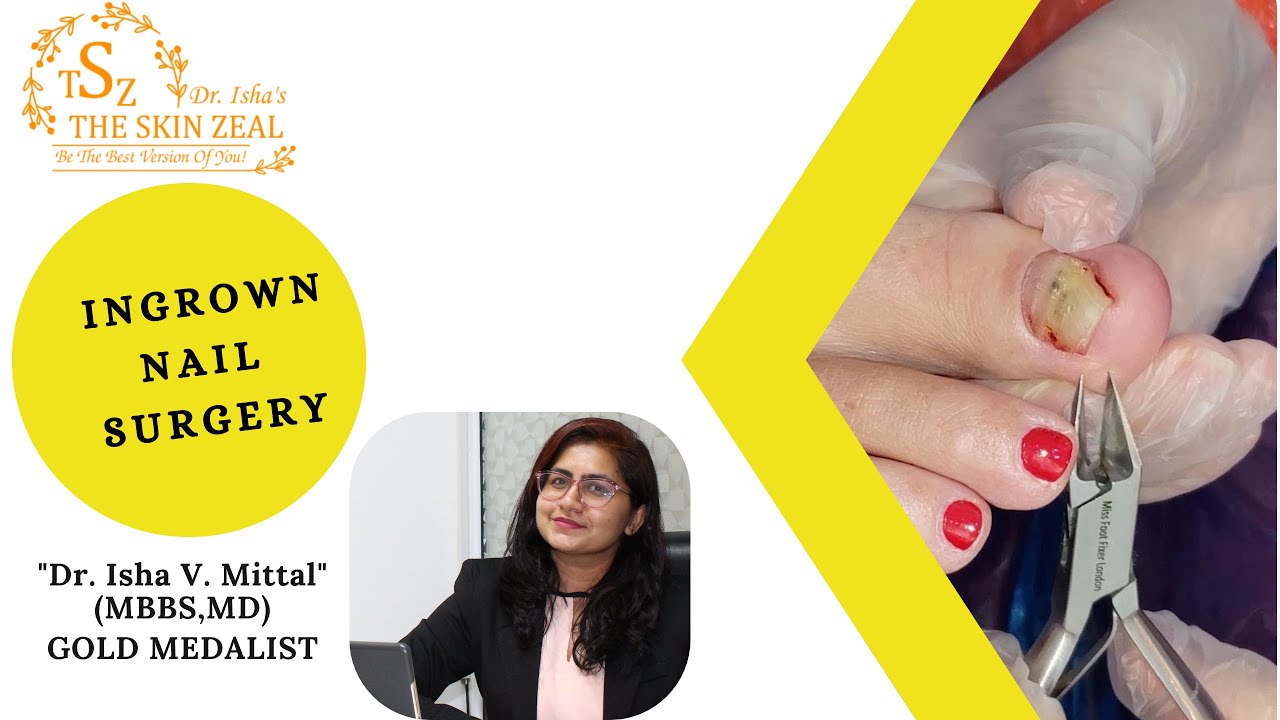 NAIL INFECTION NAIL SURGERY IN CHANDIGARH ZIRAKPUR PANCHKULA