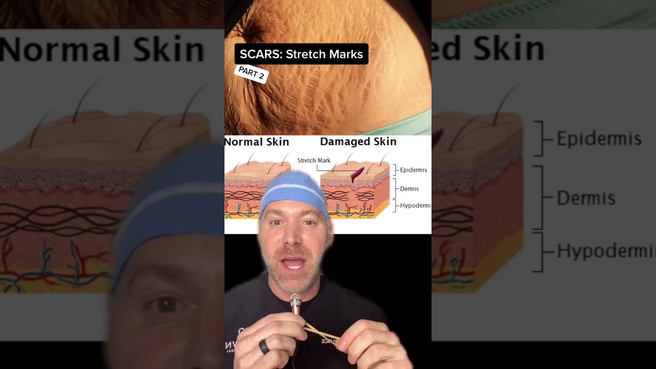 Frustrated with Stretch Marks? Try This! #shorts