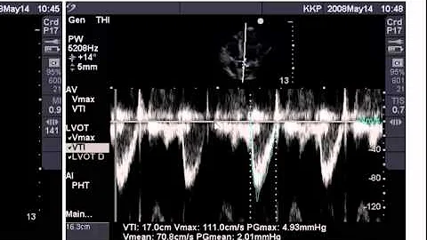 Point of Care Echo: Stroke Volume Determination