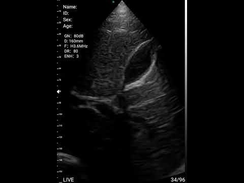 Curved Linear Array Transducer B Gallbladder - YouTube