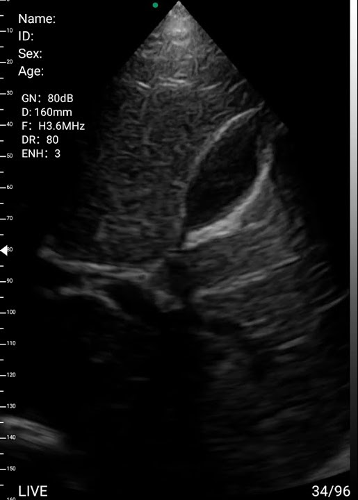 Curved Linear Array Transducer B Gallbladder - YouTube