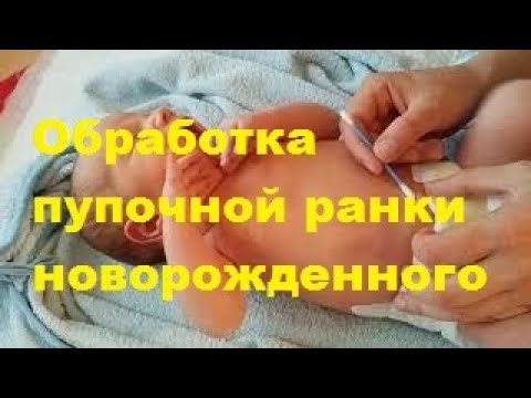 Обработка пупочной ранки новорожденного