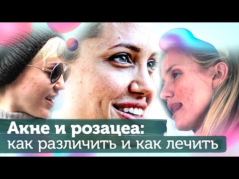Розацеа и акне: как различить и лечить