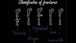 Classifying and presenting Fractures - Orthopaedics for Medical Students / Finals