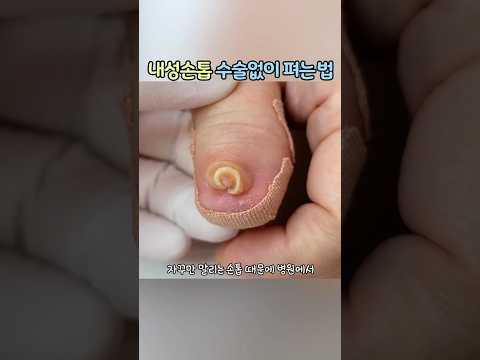 #말린손톱#손톱변형#내성손톱#레푸스화정점 #손톱 뽑고 이러지도 저러지도 못하신 어머님! 너무아프셨지만 이제는 활짝 웃으셨어요!