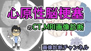 心原性脳梗塞のCT、MRI画像診断【救急画像読影の基礎】