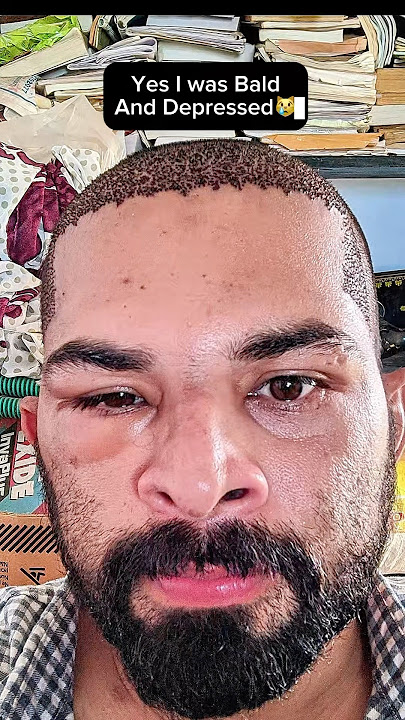 My Hair Transplant Results 99524 19890💥💥💥#ameerht #hairtransplant #hairlosstreatment