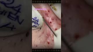 Relax Blackhead Removal 108  short blackhead  acne pimple satisfying