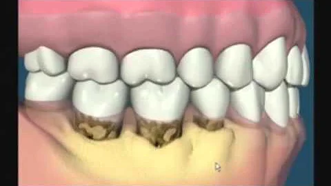 Como ocorre a doença periodontal?