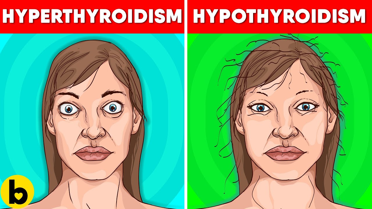 thyroid problems in women