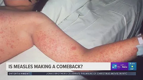 Is measles making a comeback? Health experts explain.