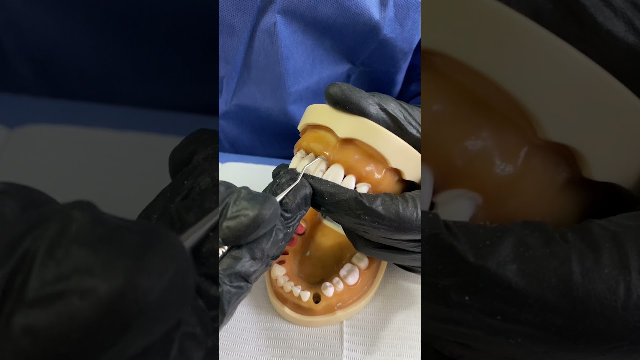 Manejo de curetas de gracey.