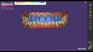 Exocad Mockup Design on Tooth 4 to 4