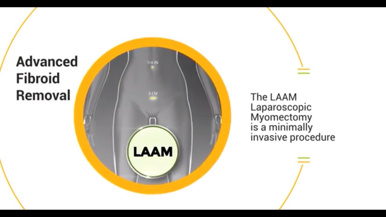 LAAM CIGC’s FastRecovery Laparoscopic Myomectomy YouTube