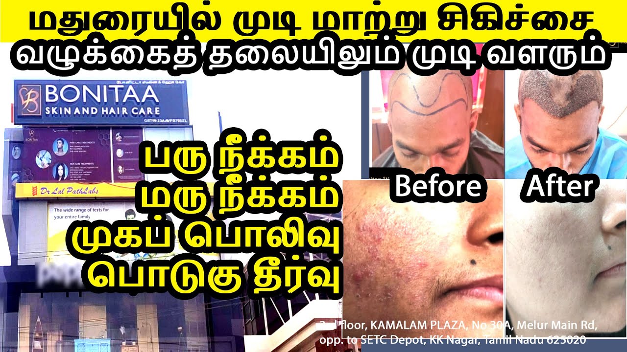 Best Treatment For Hair Loss  Hair Transplant In Madurai