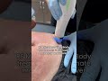 Mommy makeover with RF Microneedling! #rfmicroneedling #stretchmarksremoval #skintightening